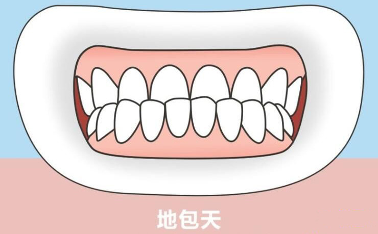 如果孩子有“地包天”，該怎么辦？